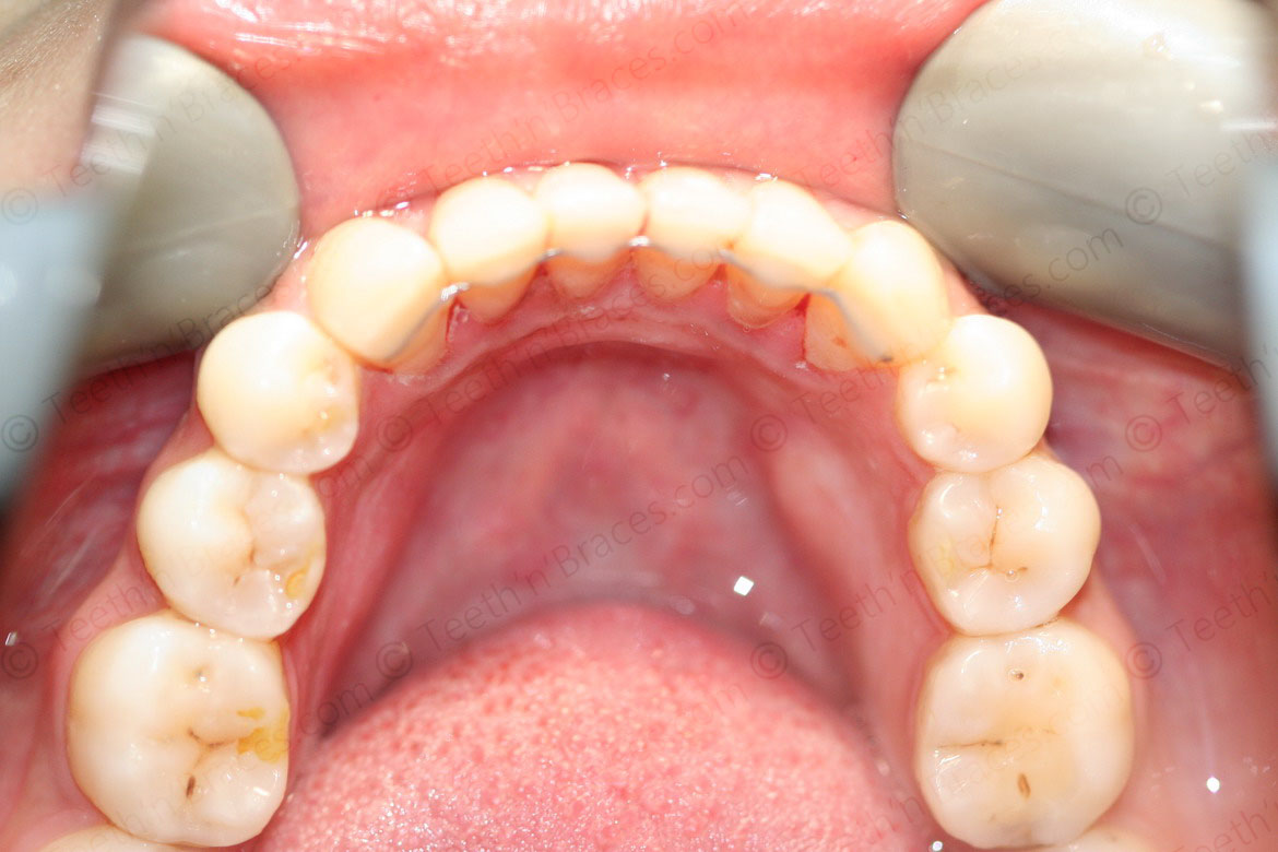 Case 5: Protrusion treated with Lingual Braces.  Teeth N Braces