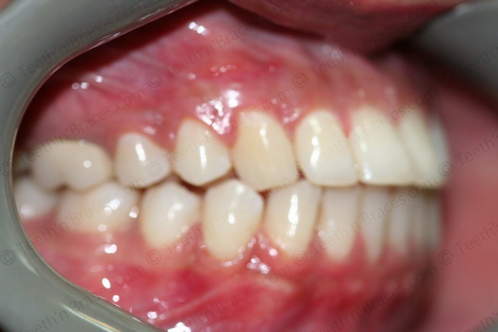 Case 5: Protrusion treated with Lingual Braces.  Teeth N Braces