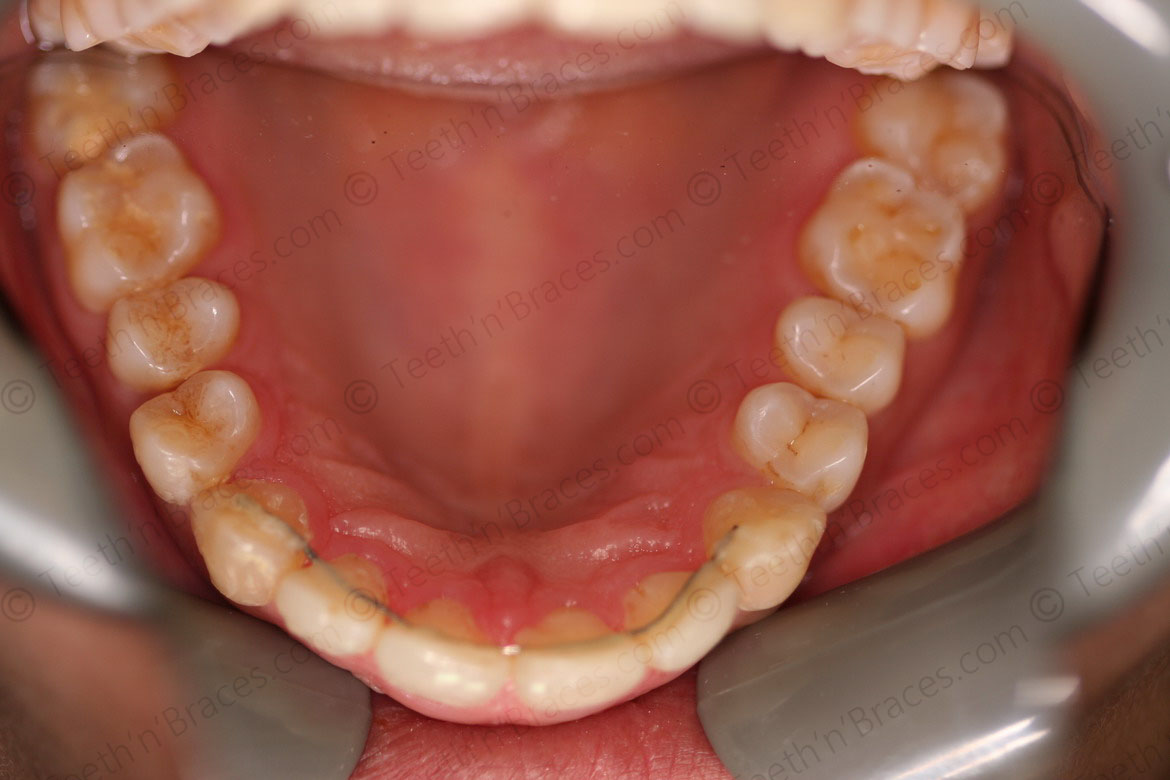 Case 1 Spacing In Anterior Teeth Teeth N Braces   4 10 