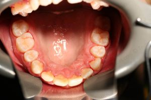 Treated Cases-POST-C11