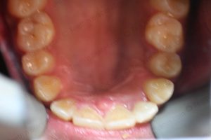 Treated Cases-POST-C16