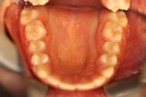 Treated Cases-POST-C30