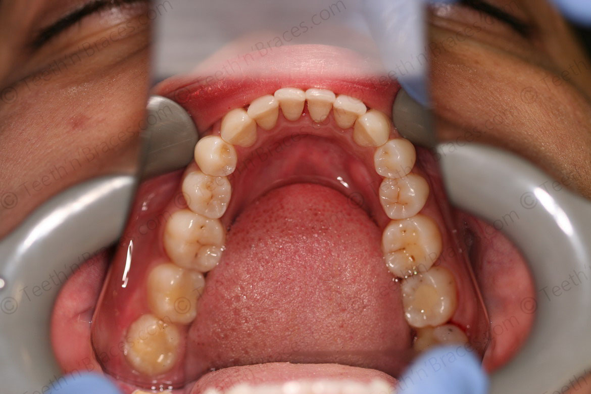 Case 5: Protrusion treated with Lingual Braces.  Teeth N Braces