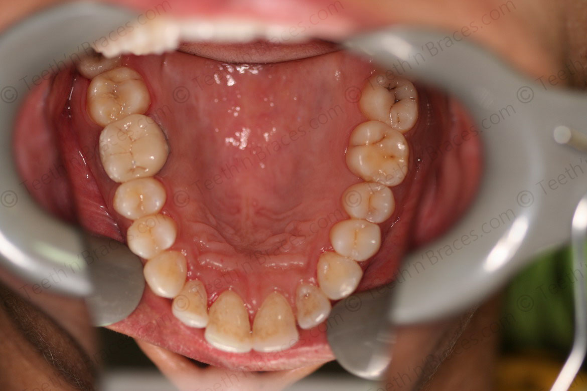 Case 5: Protrusion treated with Lingual Braces.  Teeth N Braces