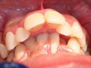 Treated Cases-PRE-C2