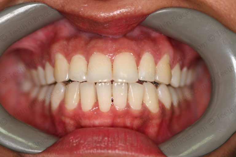 Case 5: Protrusion treated with Lingual Braces.  Teeth N Braces